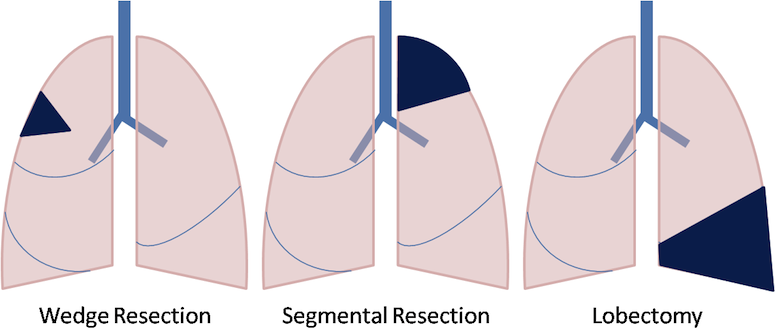 lung cancer surgery