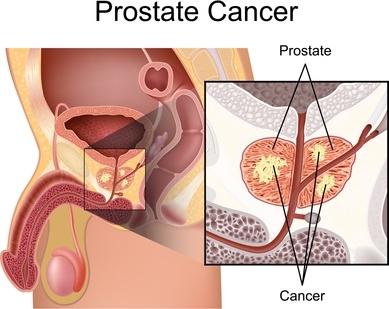 prostate cancer