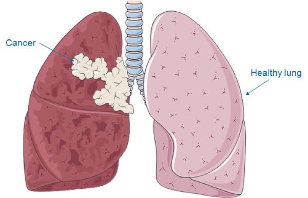 lung cancer