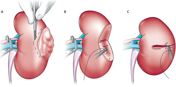 kidney cancer treatment