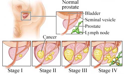 prostate cancer metastasis