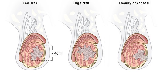 testicular cancer stages