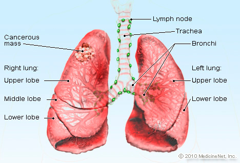 lung cancer