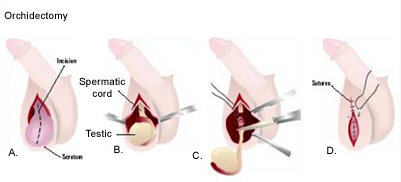 orchidectomy